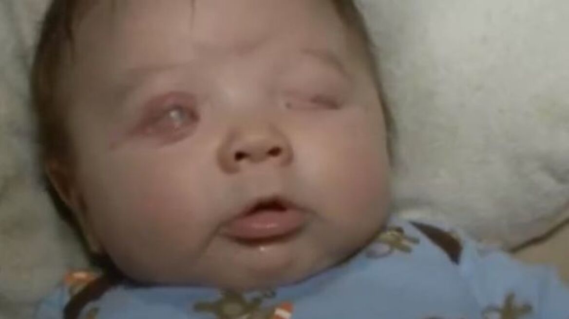 ΗΠΑ: Μωρό γεννήθηκε χωρίς μάτια!